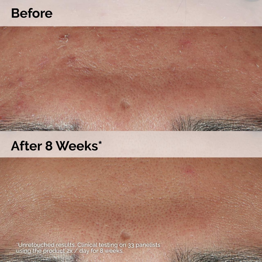 The Ordinary Niacinamide 10%+Zinc1%